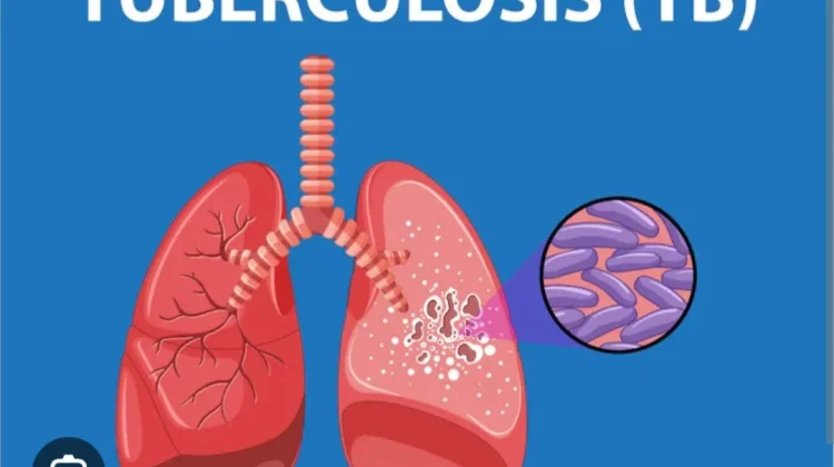 Herbal Tidak Sembuhkan Tuberkulosis