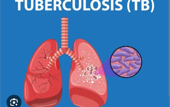 Herbal Tidak Sembuhkan Tuberkulosis
