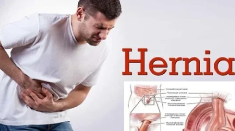 Sering Diabaikan, Hernia ternyata Ancam Nyawa Laki-Laki