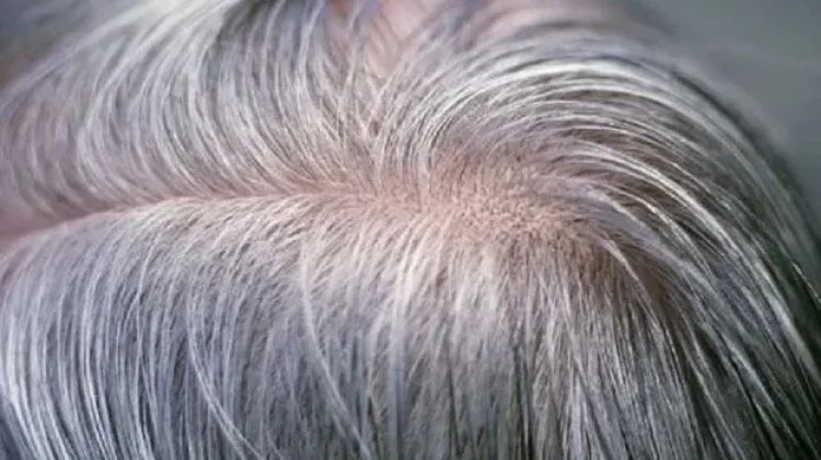 Uban Rambut yang Sering Disalahpahami