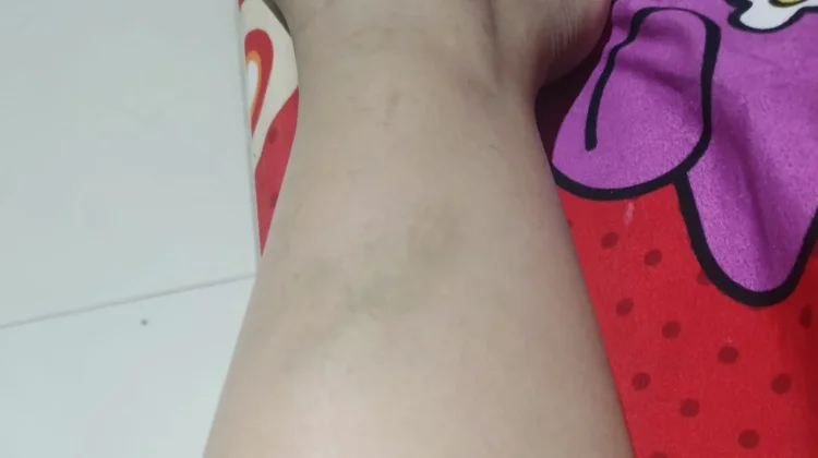 Memar Datang Tiba-Tiba, Benarkah Tanda Tubuh Lelah?