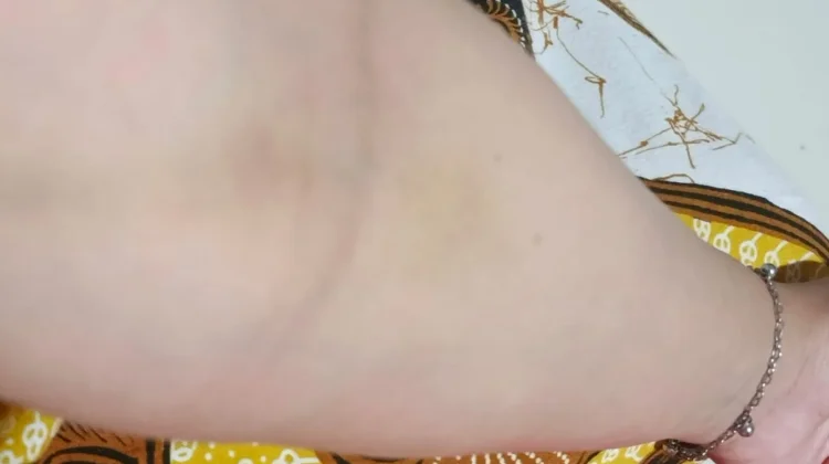 Penyebab Memar setelah Pengambilan Sampel Darah