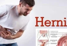 Sering Diabaikan, Hernia ternyata Ancam Nyawa Laki-Laki