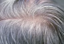 Uban Rambut yang Sering Disalahpahami