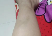 Memar Datang Tiba-Tiba, Benarkah Tanda Tubuh Lelah?