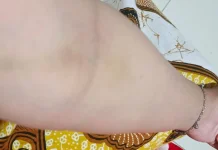 Penyebab Memar setelah Pengambilan Sampel Darah