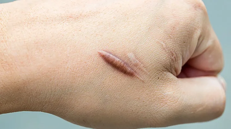 10 Bahan Alami yang Sering Digunakan untuk Merawat Keloid