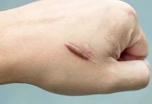 10 Bahan Alami yang Sering Digunakan untuk Merawat Keloid
