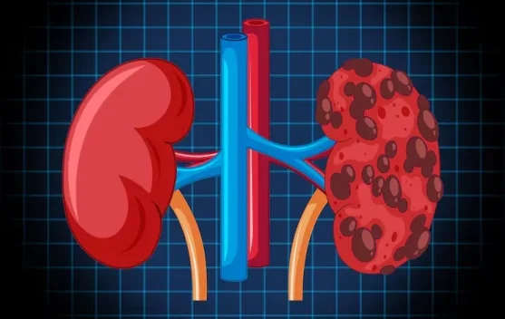 Minuman Manis Berlebih Dapat Picu Kerusakan Fungsi Ginjal
