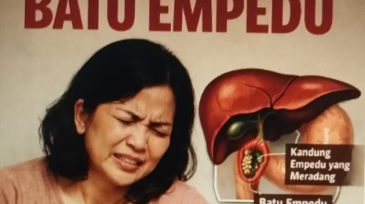 Mengenal Batu Empedu dan Cara Mengatasinya