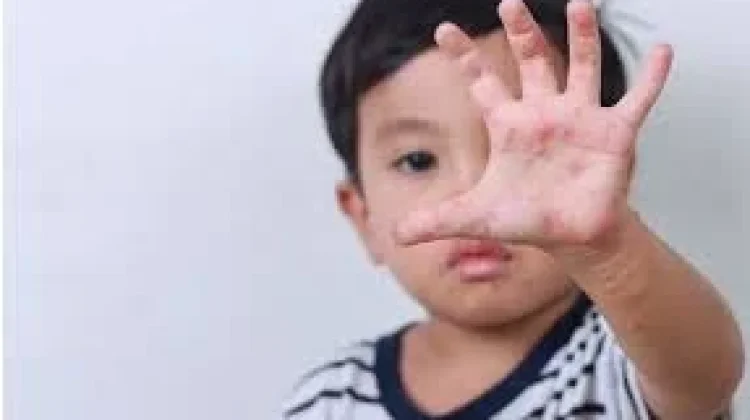 Imunisasi Jadi Kunci Cegah Penyebaran Campak