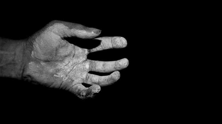 Lawan Stigma, Pakar Epidemiolog Sebut Kusta Bisa Sembuh Total jika Diobati