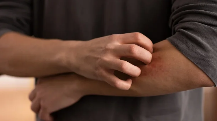 Gatal Bentol Disertai Sesak, Waspadai Reaksi Anafilaktik