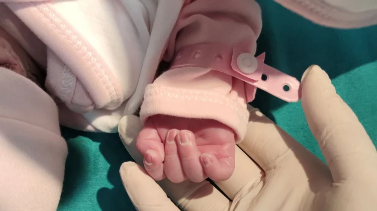 Mengenal Sindaktili, Kondisi Jari Bayi yang Saling Menempel