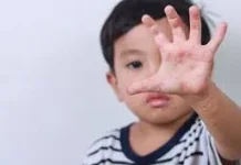 Imunisasi Jadi Kunci Cegah Penyebaran Campak