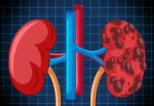 Kenali Gejala dan Penyebab Kanker Ginjal sejak Dini