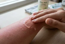 Kulit Terbakar Sinar Matahari? Ini Cara Tepat Mengatasi Sunburn