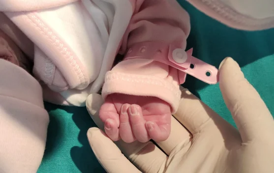 Mengenal Sindaktili, Kondisi Jari Bayi yang Saling Menempel