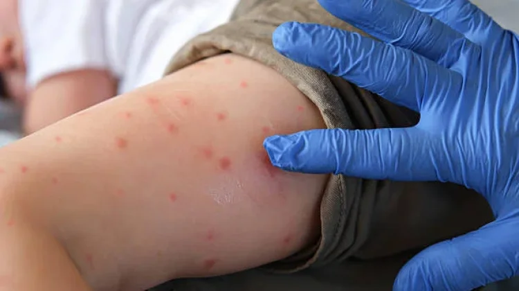 Kasus Suspek Campak di Cimahi Meningkat, Dinkes Imbau Waspada