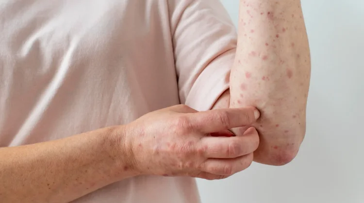 Mengenal Penyakit Scabies dan Cara Mencegah Penularannya