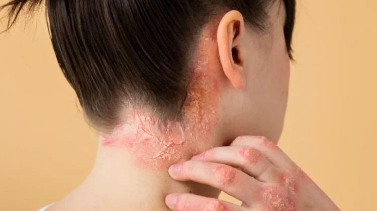 Kenali Psoriasis, Penyakit Kulit yang Sering Kambuh