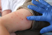 Kasus Suspek Campak di Cimahi Meningkat, Dinkes Imbau Waspada