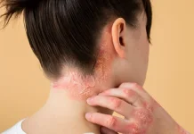 Kenali Psoriasis, Penyakit Kulit yang Sering Kambuh