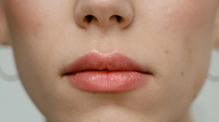 Tip Mengatasi Wajah Kemerahan Usai Treatment Kecantikan
