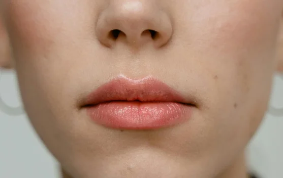 Tip Mengatasi Wajah Kemerahan Usai Treatment Kecantikan