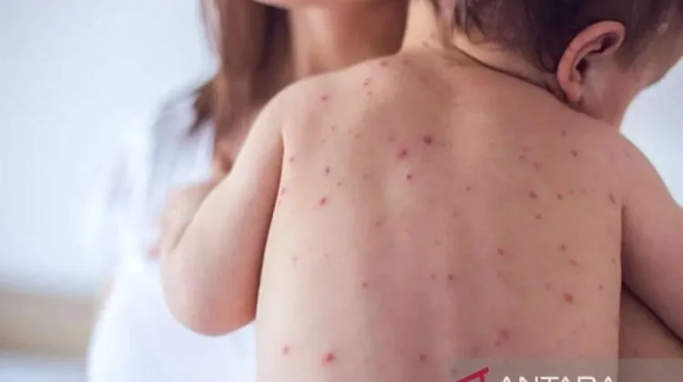 [Hoaks] Vaksin BCG atau DPT Memicu Campak pada Bayi
