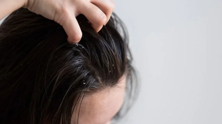 Jaga Rambut Sehat, Tips Efektif Atasi Ketombe pada Rambut