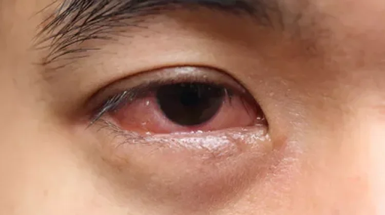 Kurang Tidur Picu Mata Lelah dan Merah