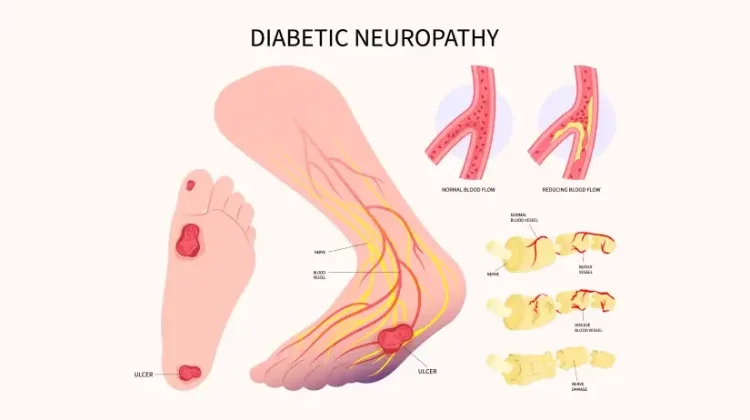 Komplikasi Diabetes Bisa Berujung Fatal