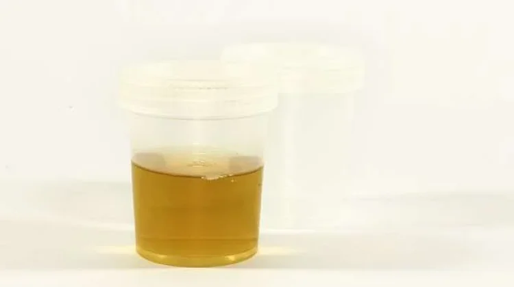 Perlu diketahui Ini Penyebab Kencing Berbusa