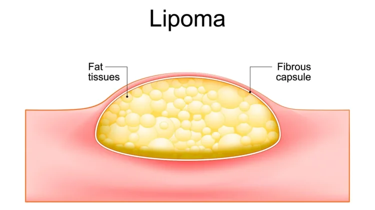 Penyebab Lipoma Bisa Muncul dan Efek Bagi Kesehatan