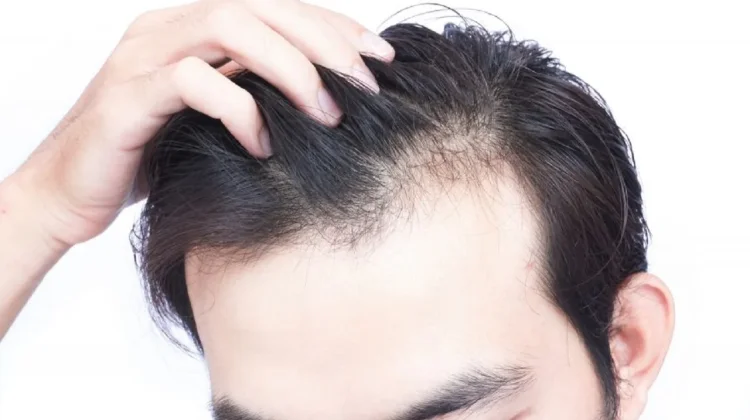 Hubungan Kurang Tidur dengan Kesehatan Rambut