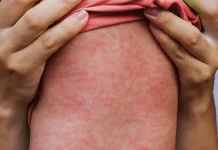 Campak pada Dewasa Bisa Lebih Parah