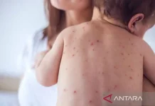 [Hoaks] Vaksin BCG atau DPT Memicu Campak pada Bayi