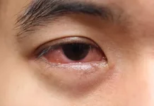 Kurang Tidur Picu Mata Lelah dan Merah