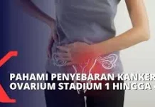 Pentingnya Hari Kanker Ovarium Sedunia untuk Wanita Dunia