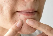 Hormon hingga Stress, Ini Penyebab Jerawat di Dagu yang Perlu Diwaspadai