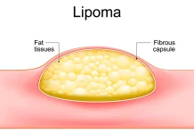 Penyebab Lipoma Bisa Muncul dan Efek Bagi Kesehatan