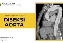 Hari Kesadaran Diseksi Aorta
