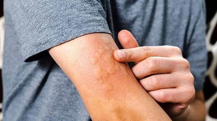 Alergi Bisa Muncul Tiba-Tiba saat Dewasa