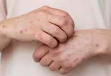 Lindungi Anak dari Campak dan Rubella