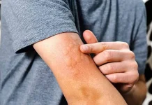 Alergi Bisa Muncul Tiba-Tiba saat Dewasa
