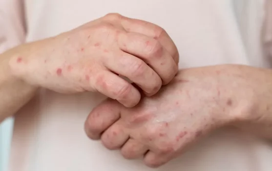 Lindungi Anak dari Campak dan Rubella