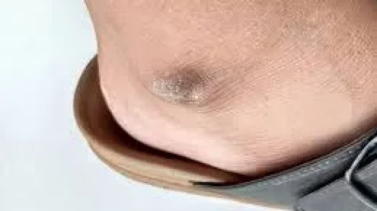 Cara Menghilangkan Bercak Hitam di Kaki