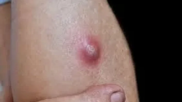 Cara Alami  Mengobati Penyakit Bisul