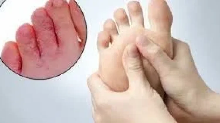 Enam Penyebab Gatal di Sela Jari-Jari Kaki